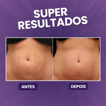 Creme AntiEstrias Removedor de Estrias e Flacidez YouShine 250g com Colágeno e Elastina Ação Rápida