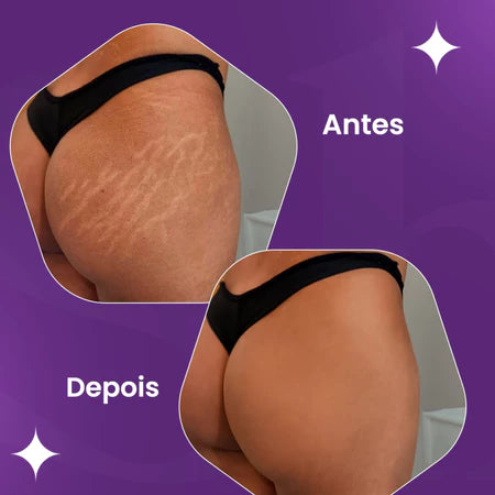 Creme AntiEstrias Removedor de Estrias e Flacidez YouShine 250g com Colágeno e Elastina Ação Rápida
